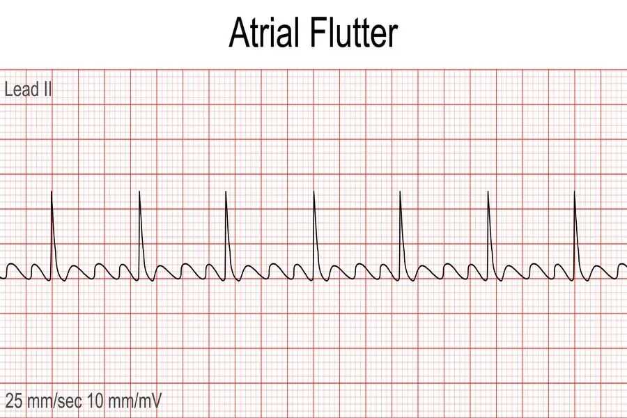 Atrial Flutter